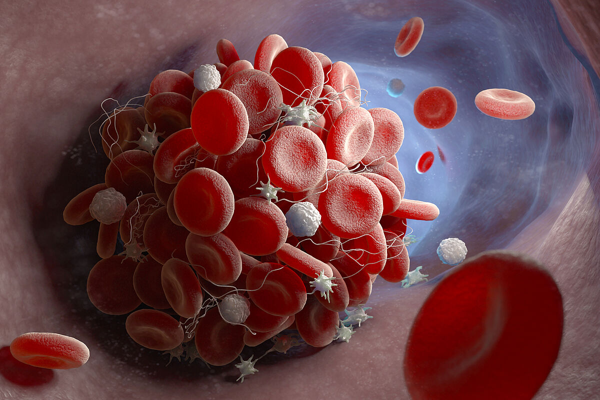 Illustration of a blood clot forming in a blood vessel 3D-Illustration of a blood clot, with a number of red blood cells forming a ball and then slowly breaking up.